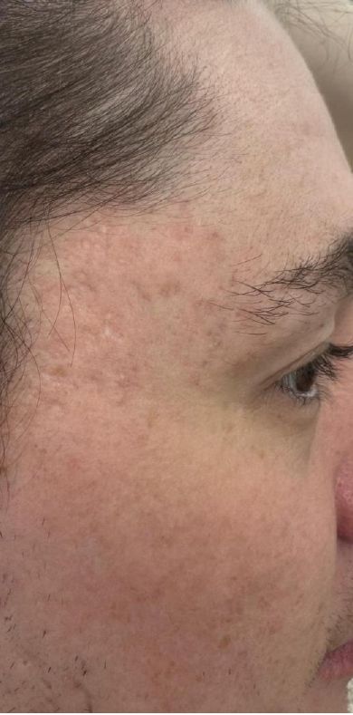 After: Juvelook acne scar treatment, smoother atrophic acne scarring