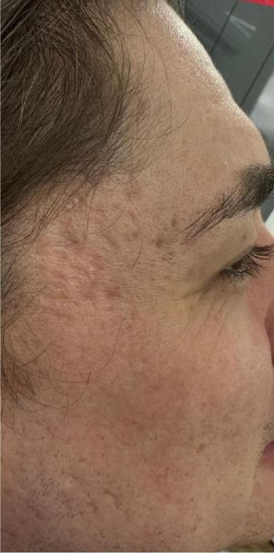 Before: Juvelook acne scar treatment, smoother atrophic acne scarring