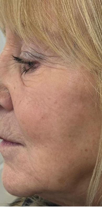 After: Juvelook and Lenisna combined, lower face, nasolabial and marionette lines