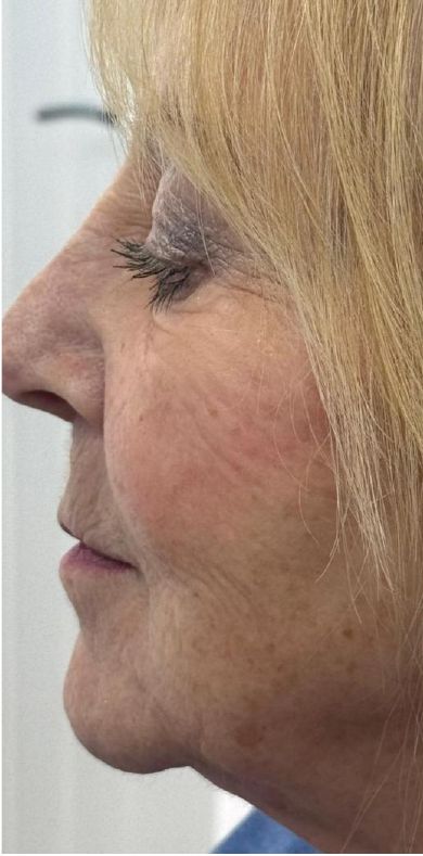 Before: Juvelook and Lenisna combined, lower face, nasolabial and marionette lines
