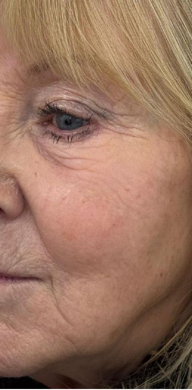 After: Juvelook and Lenisna combined, improved skin quality around the eye and cheek