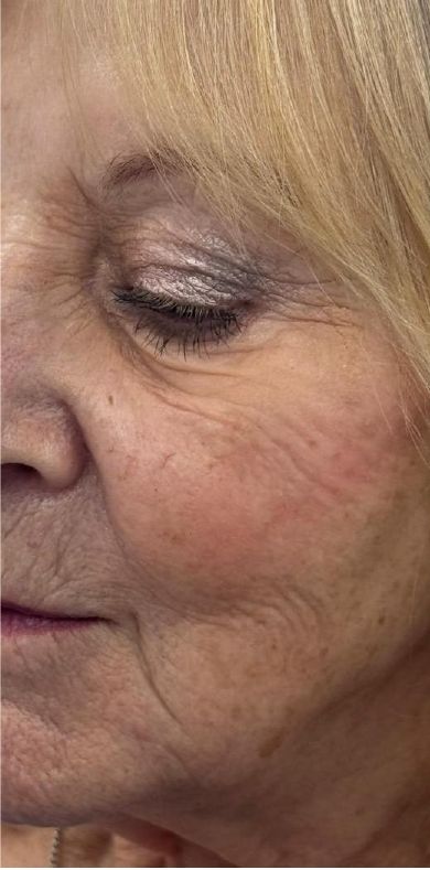 Before: Juvelook and Lenisna combined, improved skin quality around the eye and cheek