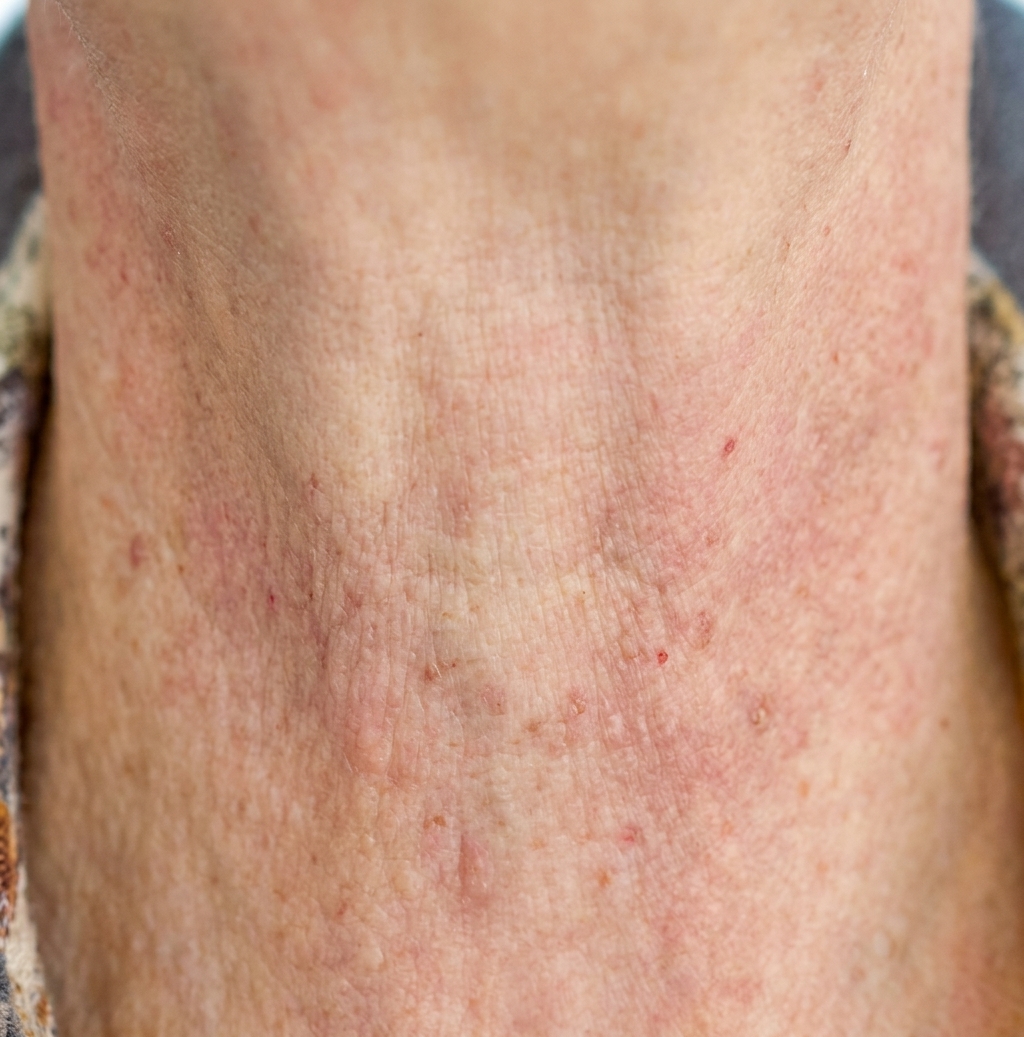 After: Juvelook neck wrinkle treatment before and after
