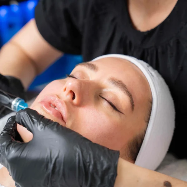 HydraFacial Skin Treatment in North London