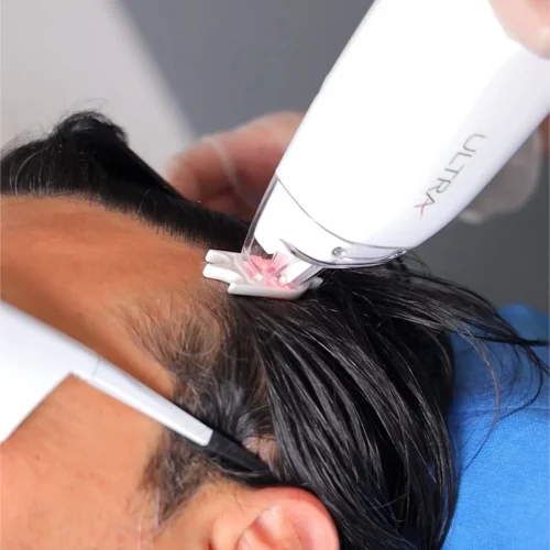 LaseMD Ultra London – Advanced Skin Resurfacing | The Axis Clinic