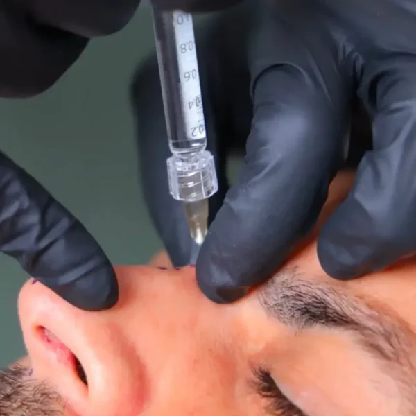 Close-up of non-surgical nose filler injection being performed at The Axis Clinic London.